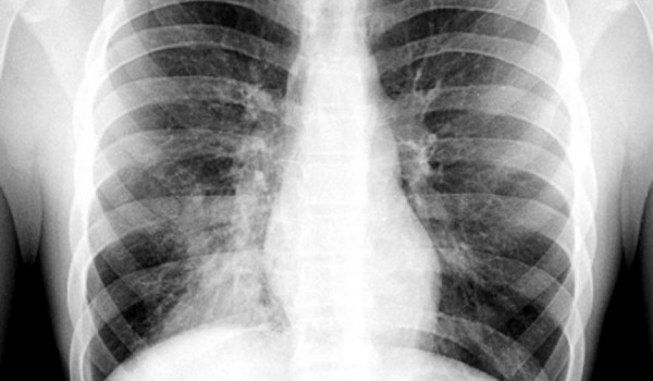 10 coisas que os pais precisam saber sobre pneumonia