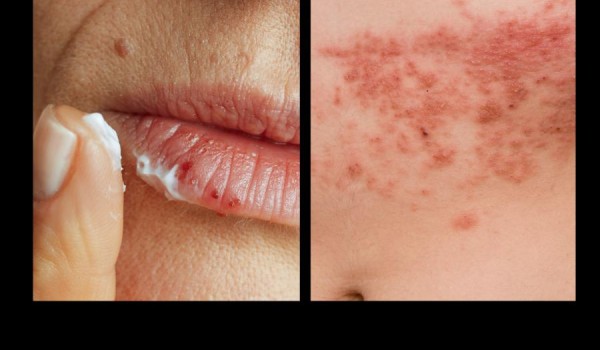 Não confundir Herpes zoster com o Herpes simplex.